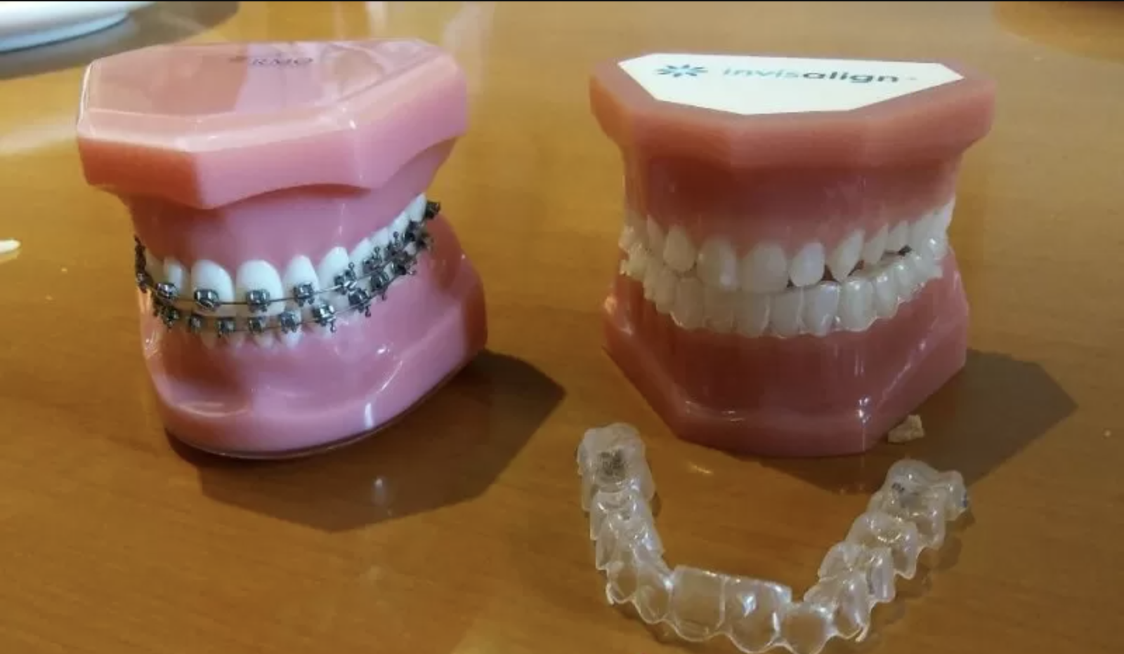 Ilustrasi gigi menggunakan kawat gigi tradisional (kiri) dan clear aligner Invisalign. (ANTARA News/Lia Wanadriani Santosa)